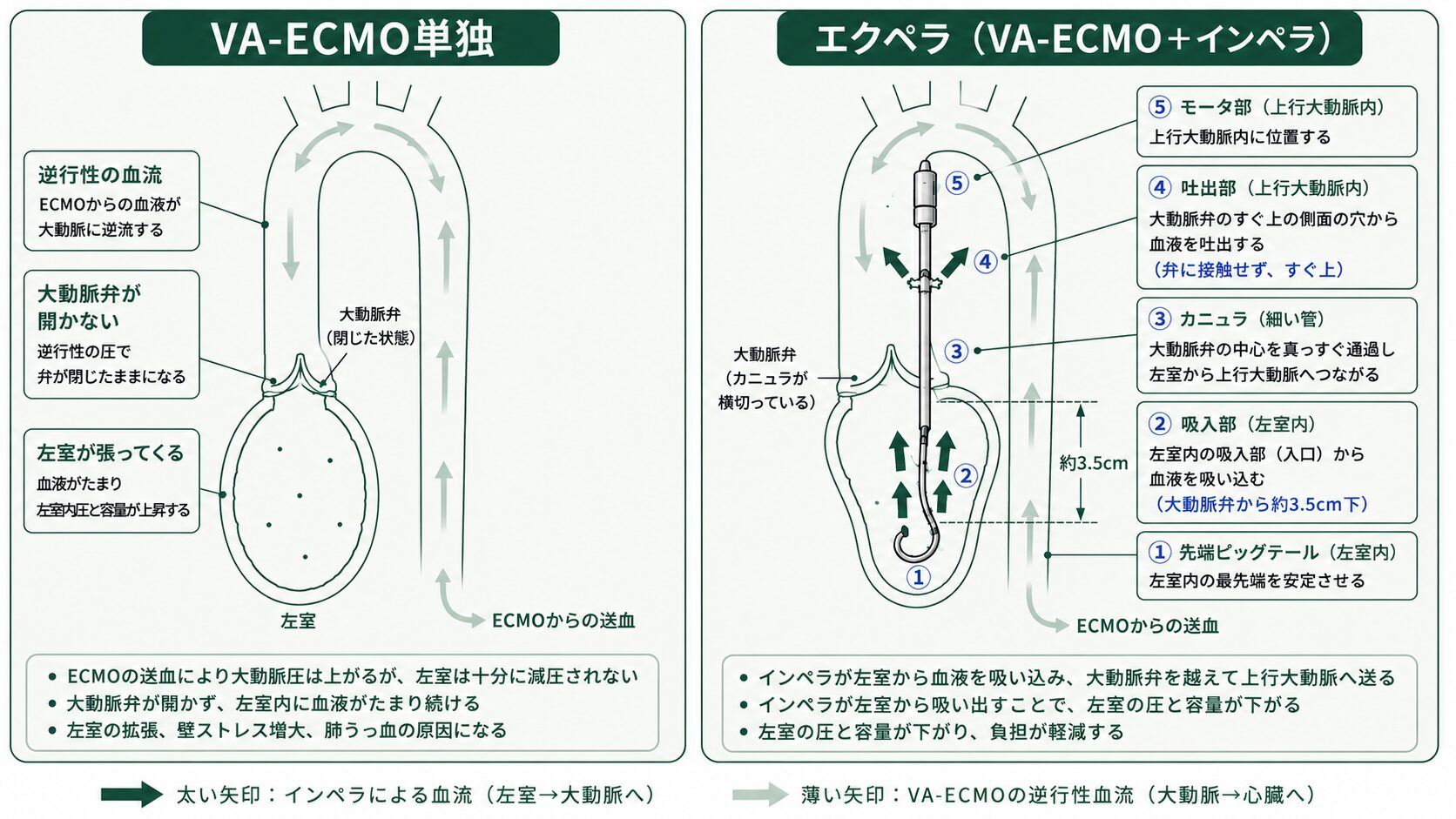 VA-ECMO単独とエクペラの比較図。VA-ECMO単独では逆行性の血流が抵抗となり大動脈弁が開かず左室が張る。エクペラではインペラのカニュラが大動脈弁の中心を通り、左室内の吸入部から吸い込んだ血液を弁のすぐ上の吐出部から上行大動脈へ送るため、左室の圧と容量が下がる。