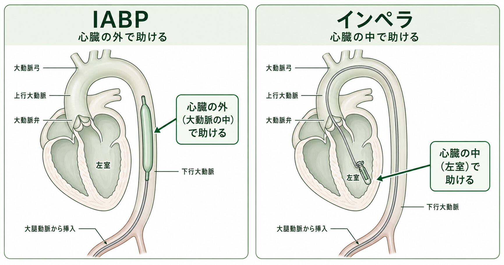 IABPとインペラの比較図。IABPは心臓の外(下行大動脈の中)にバルーンがあり、インペラはカテーテルが大動脈弁の中心を通って心臓の中(左室)まで入っている。どちらも大腿動脈から挿入され、血管の内側を通っている。