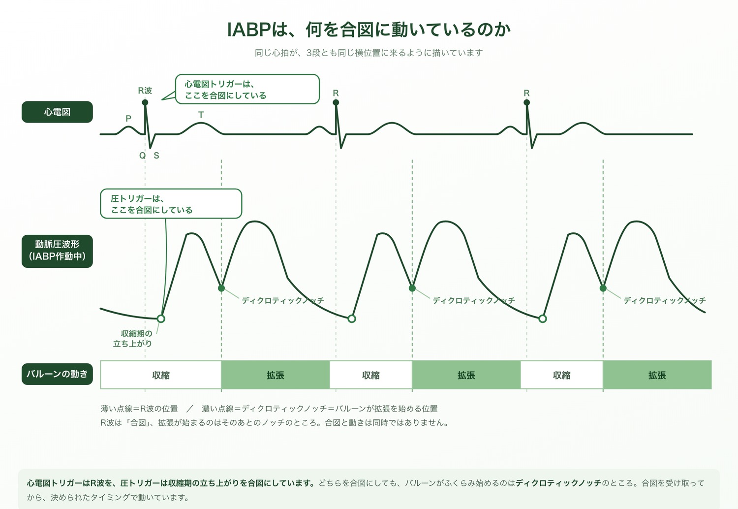 心電図・動脈圧波形・バルーンの動きを、時間軸をそろえて3段に並べた図。心電図トリガーはR波を、圧トリガーは収縮期の立ち上がりを合図にしている。どちらの場合も、バルーンが拡張を始めるのはディクロティックノッチの位置。R波は合図であり、拡張が始まるのはそのあとのノッチのところで、合図と動きは同時ではない。