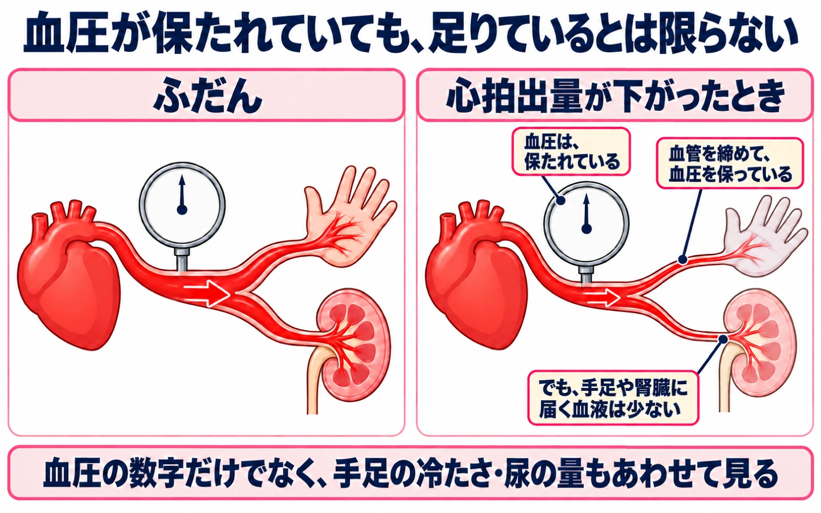 血圧が保たれていても足りているとは限らないことを示す図。左右2つのコマに、心臓、大動脈から出る太い動脈、圧力計、手と腎臓につながる細い血管が同じ配置で描かれている。左の「ふだん」では、流れの矢印が太く、手と腎臓に赤い血液がたっぷり届いている。右の「心拍出量が下がったとき」では、流れの矢印が細く、手と腎臓へ向かう血管が細く締まり、手と腎臓は青白い。圧力計の針は左右で同じ位置（血圧は保たれている／血管を締めて血圧を保っている／でも、手足や腎臓に届く血液は少ない）。下に「血圧の数字だけでなく、手足の冷たさ・尿の量もあわせて見る」。