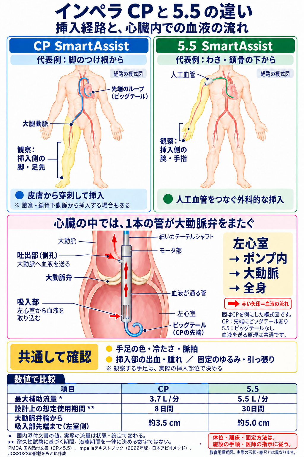 インペラCPと5.5の違いを示した図。上段の左はCP SmartAssistで、代表例として脚のつけ根の大腿動脈から皮膚を穿刺して入れ、先端のループ（ピッグテール）が左心室にある。観察は挿入側の脚・足先。腋窩・鎖骨下動脈から入れる場合もある。右は5.5 SmartAssistで、代表例としてわき・鎖骨の下の動脈に人工血管をつないで外科的に入れる。観察は挿入側の腕・手指。中段は、1本の管が大動脈弁をまたぎ、左心室の吸入部から血液を取り込み、管を通って大動脈側の吐出部から送り出すしくみの模式図。CPは先端にピッグテールがあり、5.5にはない。下段の共通の確認は、手足の色・冷たさ・脈拍、挿入部の出血・腫れ、固定のゆるみ・引っ張り。数値の比較は、最大補助流量がCP 3.7L/分・5.5 5.5L/分、設計上の想定使用期間がCP 8日間・5.5 30日間、大動脈弁輪から吸入部先端までがCP約3.5cm・5.5約5.0cm。