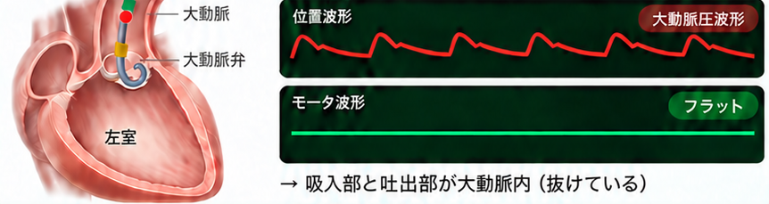 ポンプ位置 大動脈内の波形。位置波形は大動脈圧波形のまま、モータ波形はフラット。吸入部も吐出部も大動脈弁より上に抜けている。