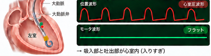 ポンプ位置 心室内の波形。位置波形は心室圧波形に変わり、モータ波形はフラット。吐出部と光学センサが大動脈弁より下に入っている。