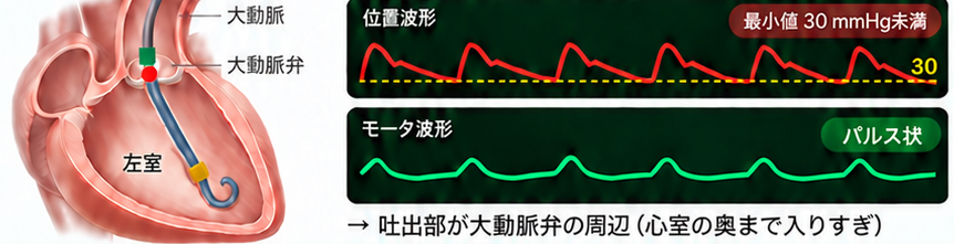 位置感知用信号 最小値 低値の波形。位置波形の最小値が30mmHgの線を下回り、モータ波形はパルス状のまま。吐出部が大動脈弁の周辺にあり、心室の奥まで入りすぎている。