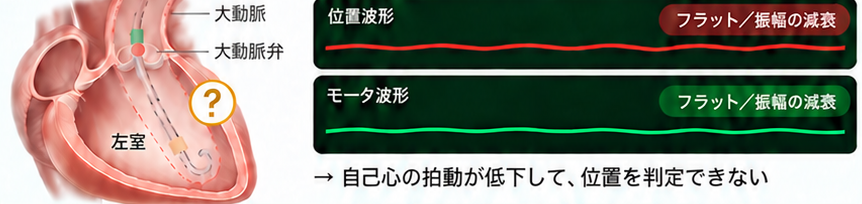 ポンプ位置 不明の波形。位置波形もモータ波形も振れ幅が小さく、ほぼフラット。自己心の拍動が低下して、位置を判定できない。