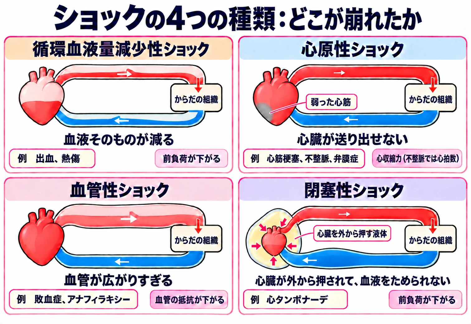 ショックの4つの種類を比べた図。4つとも同じ形の輪の図で、左の心臓から赤い動脈で右の「からだの組織」へ血液を送り、青い静脈で心臓に戻る。左上の循環血液量減少性ショックは、管と心臓の中の血液が少ない（血液そのものが減る。例：出血、熱傷。前負荷が下がる）。右上の心原性ショックは、心臓の壁の一部が灰色になっていて（弱った心筋）、送り出す矢印が細い（心臓が送り出せない。例：心筋梗塞、不整脈、弁膜症。心収縮力、不整脈では心拍数）。左下の血管性ショックは、動脈が大きく広がっている（血管が広がりすぎる。例：敗血症、アナフィラキシー。血管の抵抗が下がる）。右下の閉塞性ショックは、心臓のまわりを黄色い液体が囲んで内側へ押し、心臓が小さく縮こまっている（心臓が外から押されて、血液をためられない。例：心タンポナーデ。前負荷が下がる）。